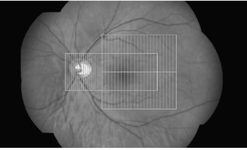 A retinal scan with a measurement grid overlaid.